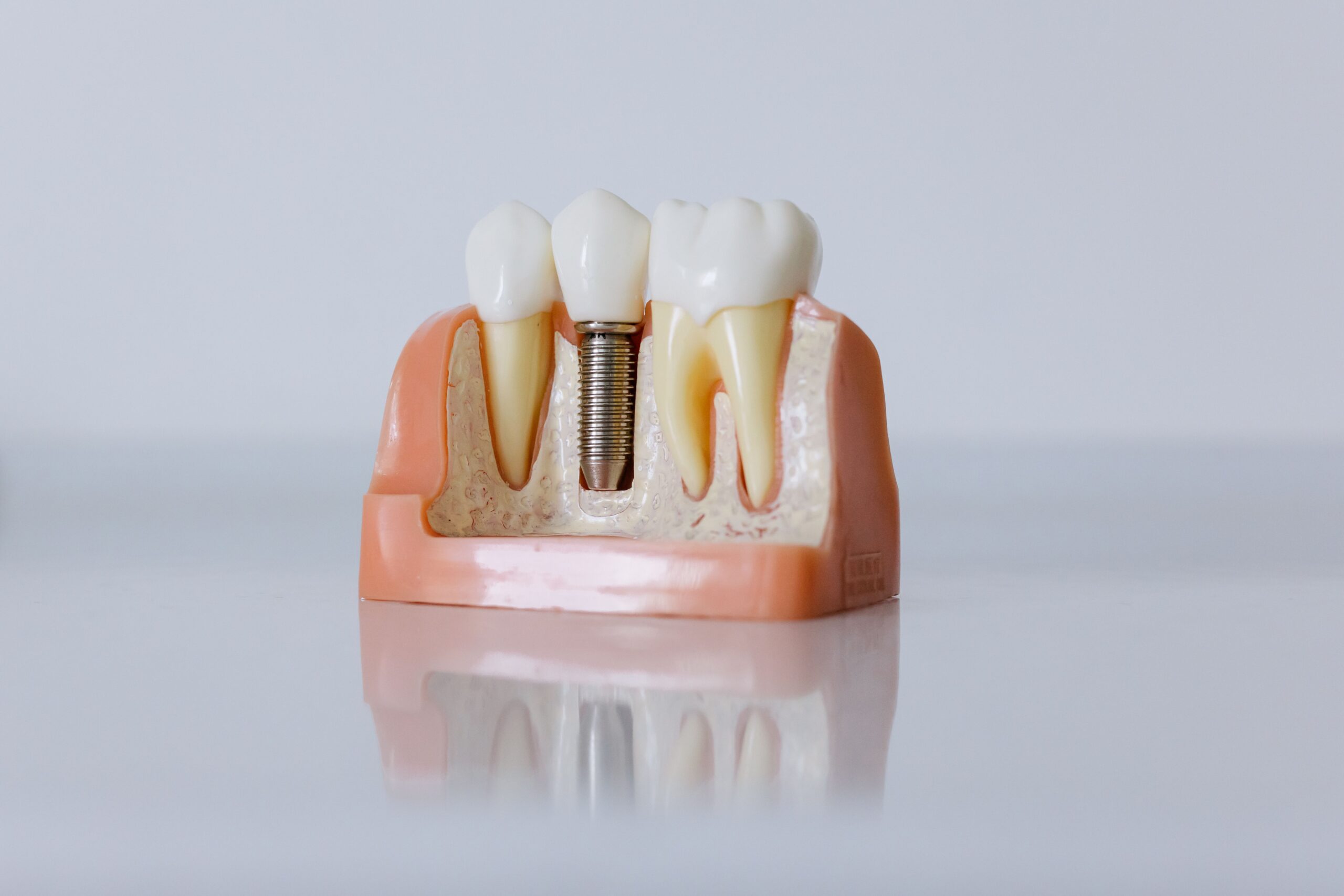Detailed dental implant model showcasing teeth structure for educational purposes.